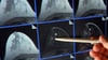 Auf einer Magnetresonanz-(MR)-Mammographie ist ein winziger Tumor in der Brust einer Patientin zu sehen. Foto: Jan-Peter Kasper