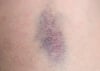 Wenn bereits leichte Stöße häufig zu blauen Flecken führen, kann das auf eine Störung der Blutgerinnung hinweisen.