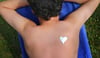 Bei diesem Trend sehen Hautärzte rot: Junge Leute legen sich derzeit Schablonen auf die Haut - und lassen sich dann absichtlich von der Sonne verbrennen. Gewünschtes Ergebnis: ein zeitlich befristetes Tattoo. Tatsächliches Ergebnis: ein Sonnenbrand.