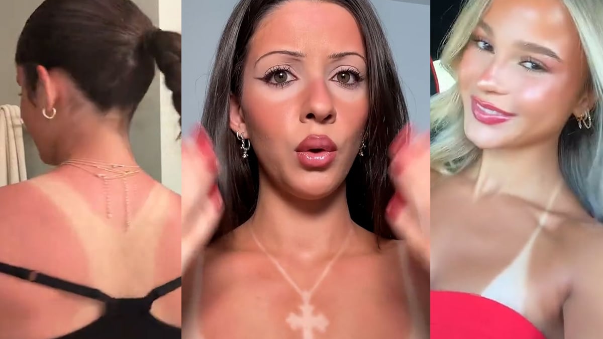 Bikinistreifen als Modetrend? Experten warnen vor Gefahr für die Gesundheit